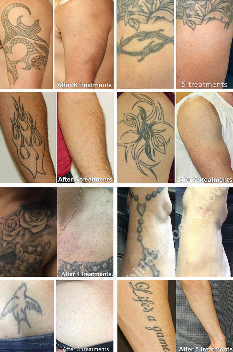 Laser Tattoo Removal | PicoSure® | Scar Treatment